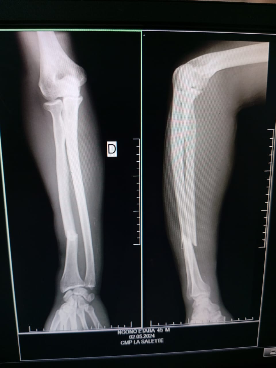 Radio avant l'opération